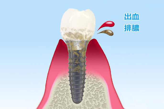 インプラント周囲炎