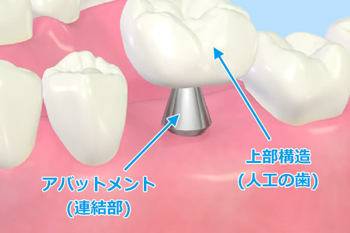 人工歯の装着