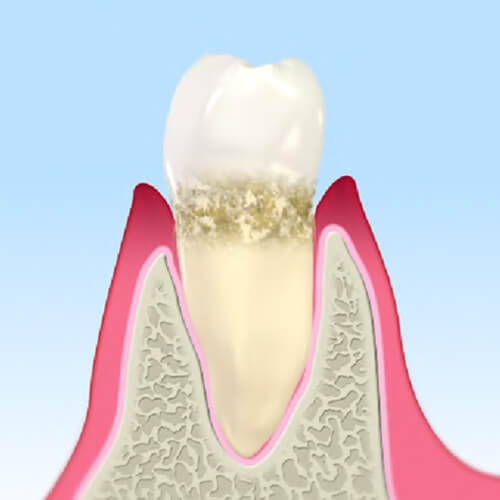 軽度の歯周病